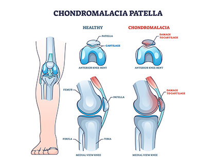 Anterior knee pain - Knee anatomy