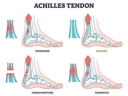 Achilles tendon infographic
