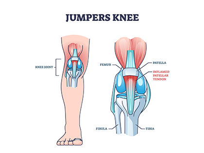 Jumper's Knee Infographic