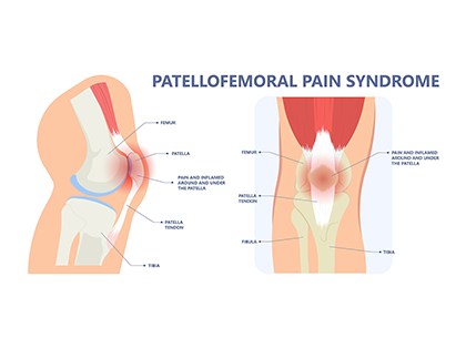 Patellofemoral Pain Syndrome (PFPS) infographic