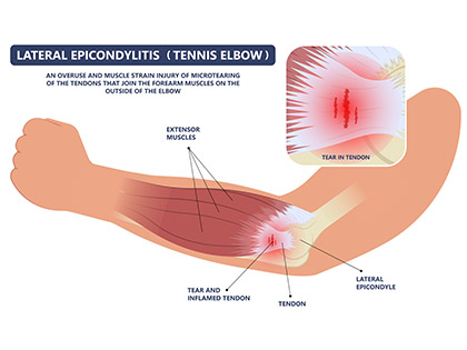 Tennis elbow infographic